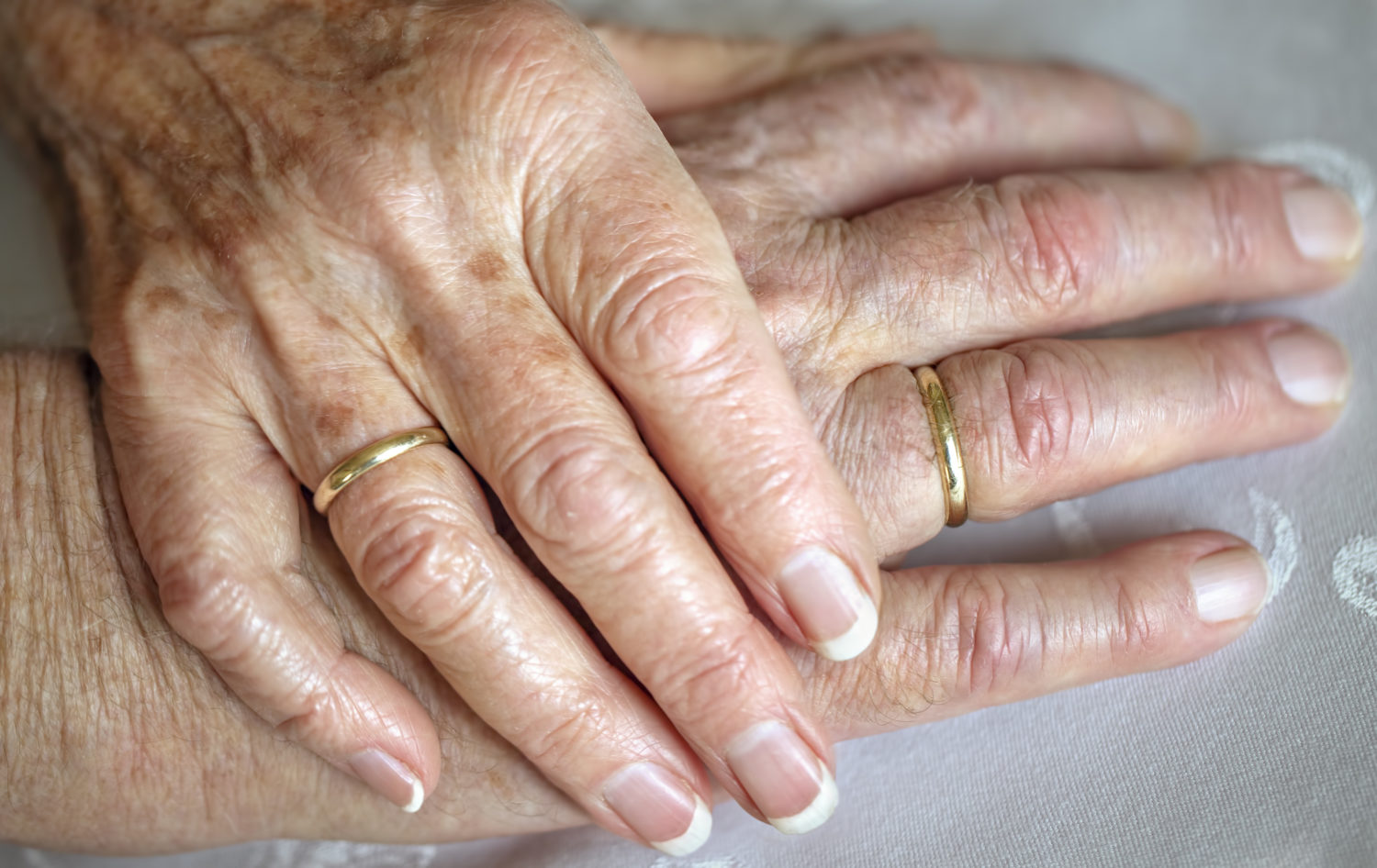 Osteoarthritis in Hands