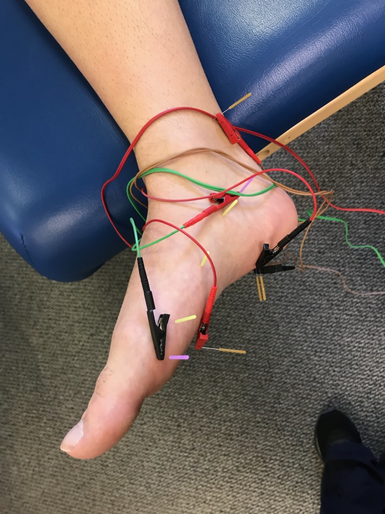 Dry Needling, Perspective from a Certified PT
