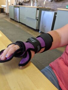 Post CVA Custom Orthosis to ensure lengthening of all flexor tendons remains intact and thumb abduction remains intact.