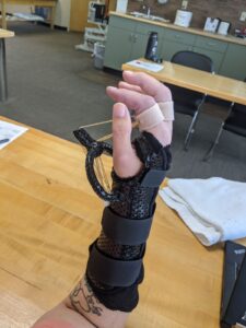 Custom orthosis to MCP flexion contractures, collateral ligament stiffness, pain. 90 Degree angle is key 